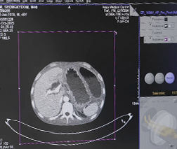 굿네이버스 위기 가정 후원 | 복부 CT 사진